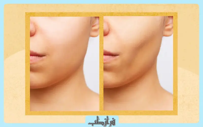 قرص چاقی صورت فت فیس چند روزه جواب می دهد