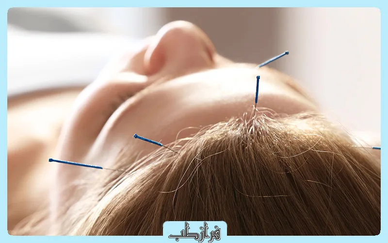 طب سوزنی برای میگرن